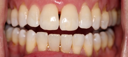 After Invisalign Treatment Reading Smiles