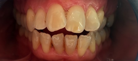 Before Invisalign Treatment Reading Smiles