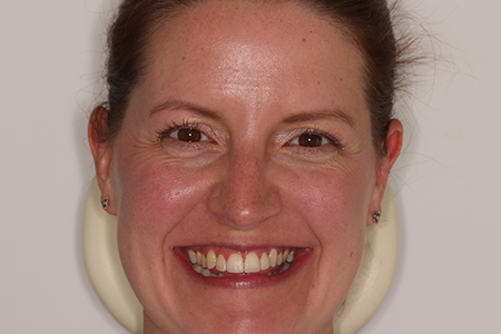 After Invisalign Treatment Reading Smiles