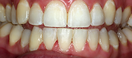After Invisalign Treatment Reading Smiles