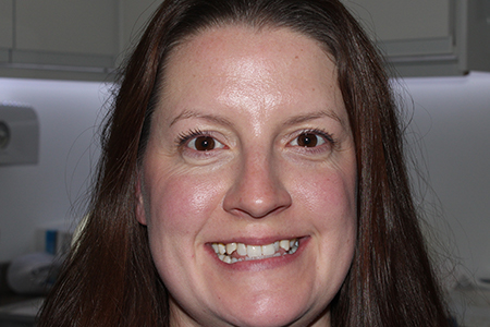 Before Invisalign Treatment Reading Smiles