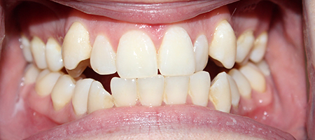 Before Invisalign Treatment Reading Smiles