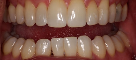 After Invisalign Treatment Reading Smiles