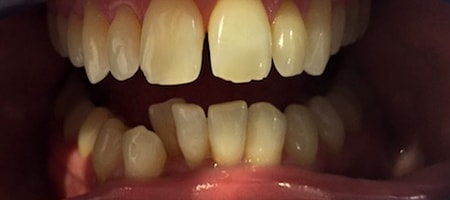Before Invisalign Treatment Reading Smiles