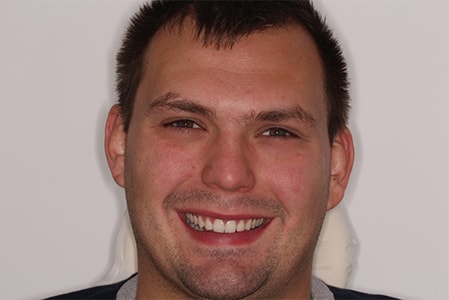 After Invisalign Treatment Reading Smiles