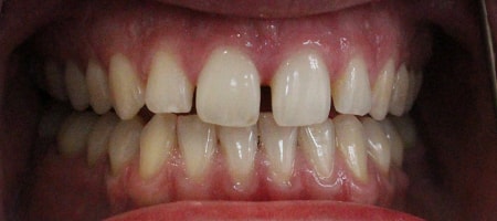 Before Invisalign Treatment Reading Smiles