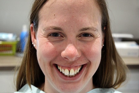 Before Invisalign Treatment Reading Smiles