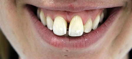 Before Invisalign Treatment Reading Smiles