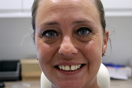 Before Invisalign Treatment Reading Smiles