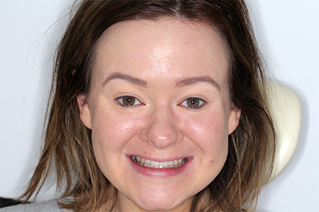 After Invisalign Treatment Reading Smiles