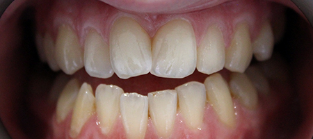 Before Invisalign Treatment Reading Smiles