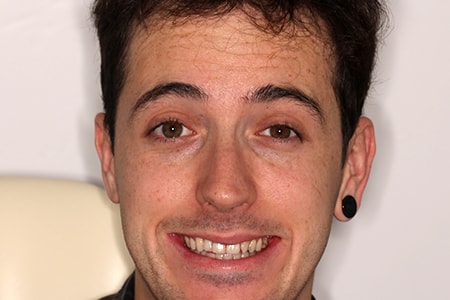 Before and After Invisalign Treatment Windsor Before and After Invisalign Treatment Windsor