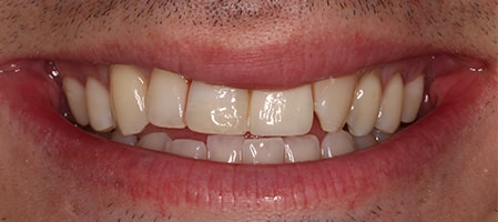 Before and After Invisalign Treatment Windsor Before and After Invisalign Treatment Windsor
