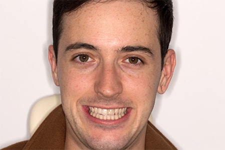 Before and After Invisalign Treatment Windsor Before and After Invisalign Treatment Windsor