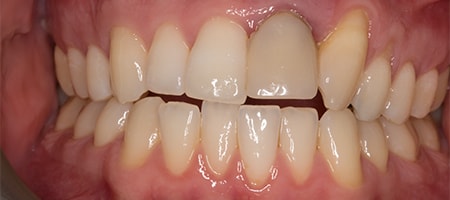 Before and After Invisalign Treatment Windsor Before and After Invisalign Treatment Windsor