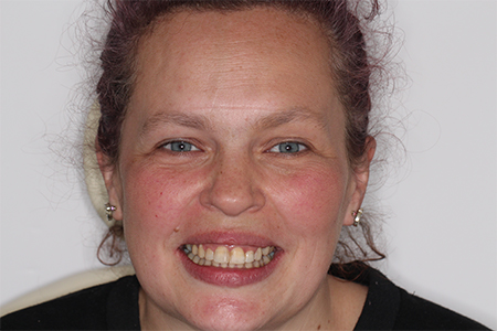 After Invisalign Treatment Reading Smiles