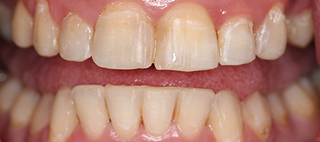 After Invisalign Treatment Reading Smiles