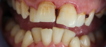 Before Invisalign Treatment Reading Smiles