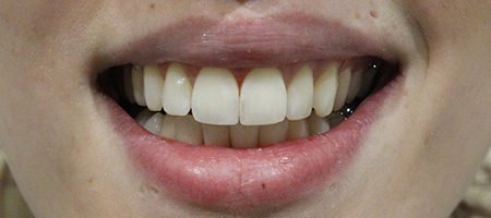 Before and After Invisalign Treatment Windsor Before and After Invisalign Treatment Windsor