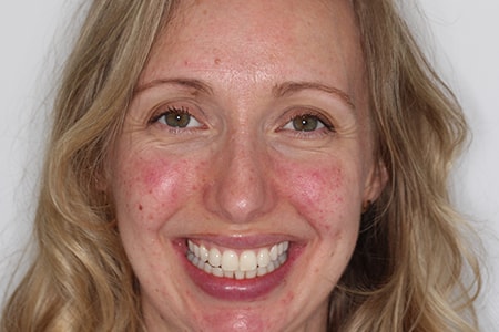 After Invisalign Treatment Reading Smiles