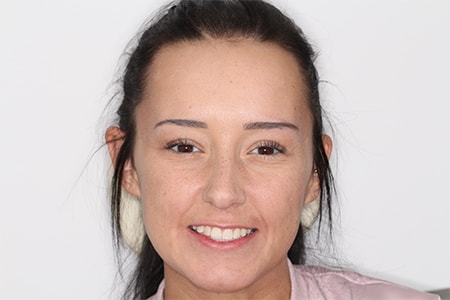 After Invisalign Treatment Reading Smiles