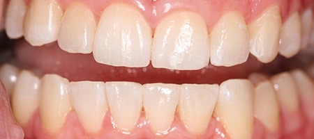 After Invisalign Treatment Reading Smiles