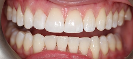 After Invisalign Treatment Reading Smiles