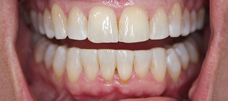 After Invisalign Treatment Reading Smiles