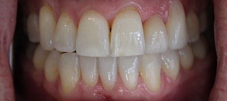 After Invisalign Treatment Reading Smiles