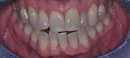 Before Invisalign Treatment Reading Smiles