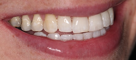 After Invisalign Treatment Reading Smiles