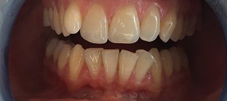 Before Invisalign Treatment Reading Smiles