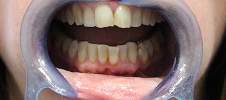 Before Invisalign Treatment Reading Smiles