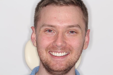 After Invisalign Treatment Reading Smiles