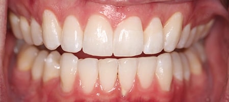 After Invisalign Treatment Reading Smiles
