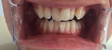 Before Invisalign Treatment Reading Smiles