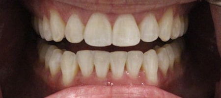 After Invisalign Treatment Reading Smiles