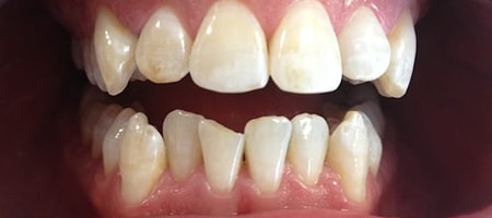 Before Invisalign Treatment Reading Smiles