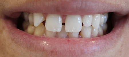 Before Invisalign Treatment Reading Smiles