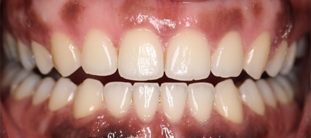After Invisalign Treatment Reading Smiles