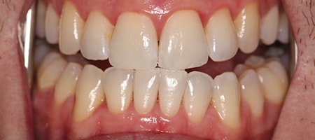 After Invisalign Treatment Reading Smiles