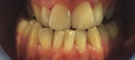 Before Invisalign Treatment Reading Smiles