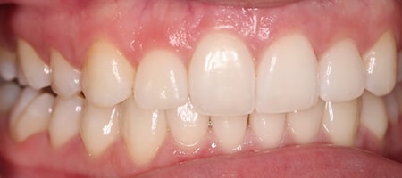 After Invisalign Treatment Reading Smiles