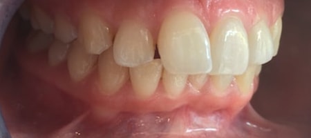 Before Invisalign Treatment Reading Smiles