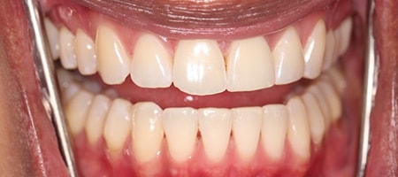 After Invisalign Treatment Reading Smiles