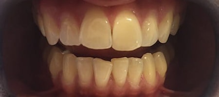 Before Invisalign Treatment Reading Smiles