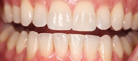 After Invisalign Treatment Reading Smiles