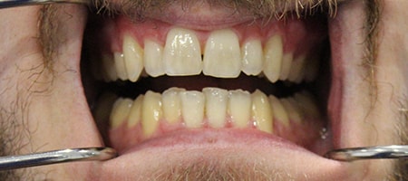 Before Invisalign Treatment Reading Smiles