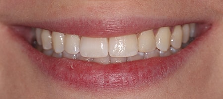After Invisalign Treatment Reading Smiles