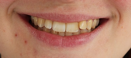 Before Invisalign Treatment Reading Smiles